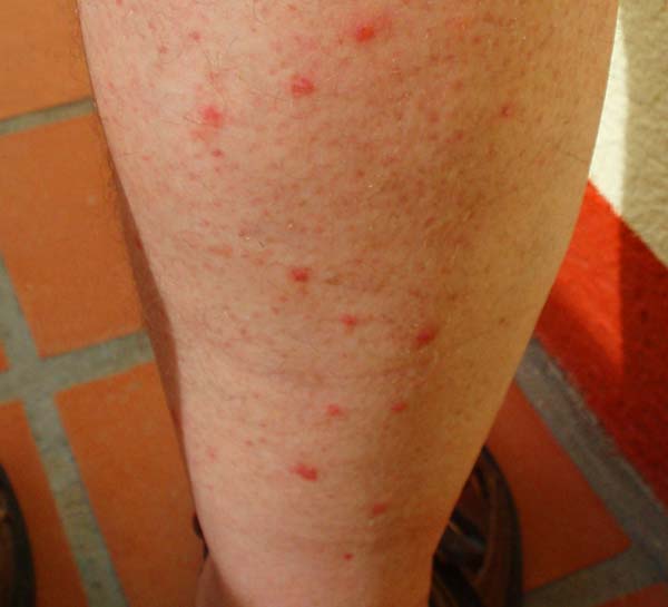 I soon learned that deet was essential when fishing from the beach.